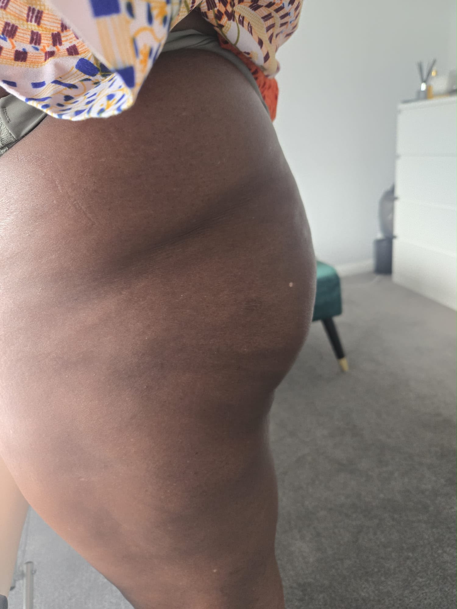 Client before Liquid BBL treatment — standing side view of natural shape